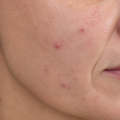 Volwassen acne bij vrouwen, behandeling bij CELINIQ