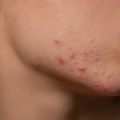 Hormonale acne op de kaaklijn bij vrouwen